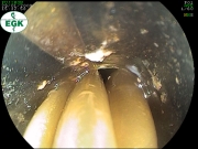 Pohled z endoskopu na přečnívající část převlečené trubice při extrakci