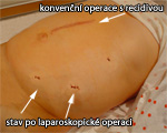 Porovnání klasické a laparoskopické operace kýly